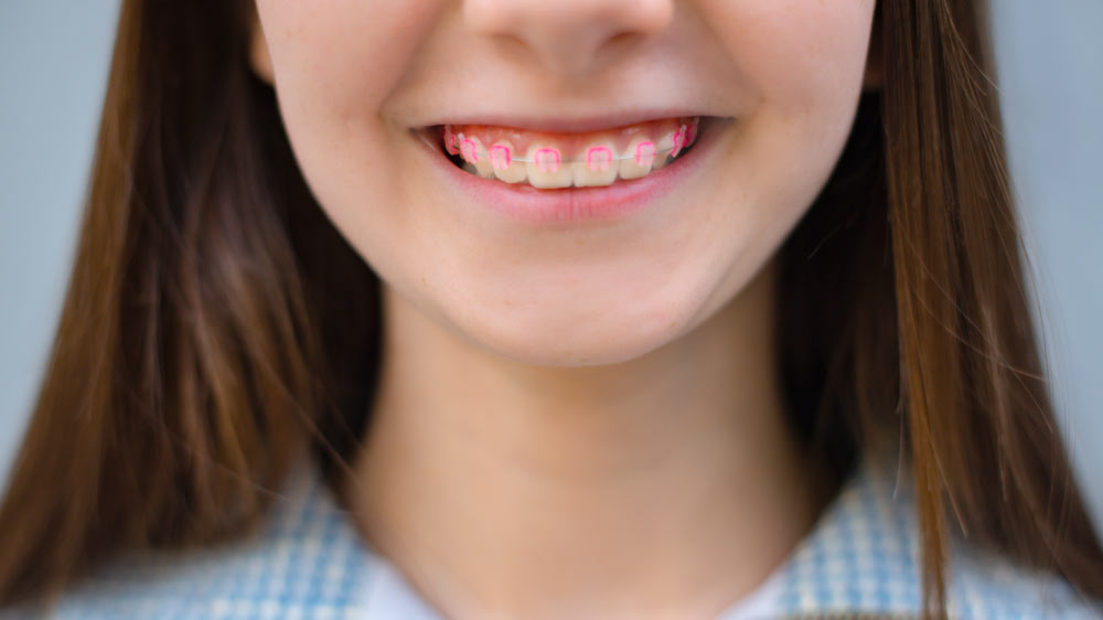 When should kids get braces?